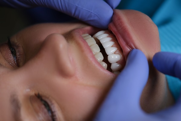 How Veneers Are Used In Cosmetic Dentsitry